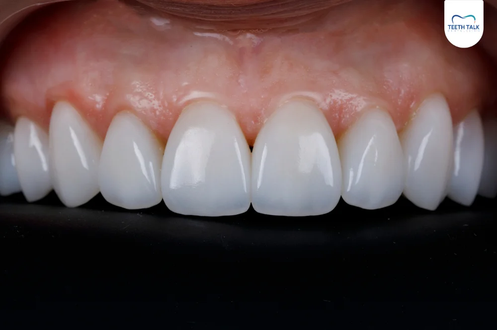 วีเนียร์แบบฉีดแตกต่างจากวีเนียร์แบบอื่นอย่างไร