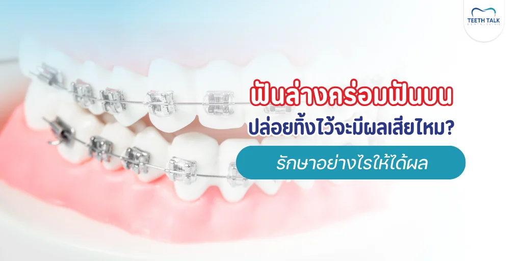 ฟันล่างคร่อมฟันบน