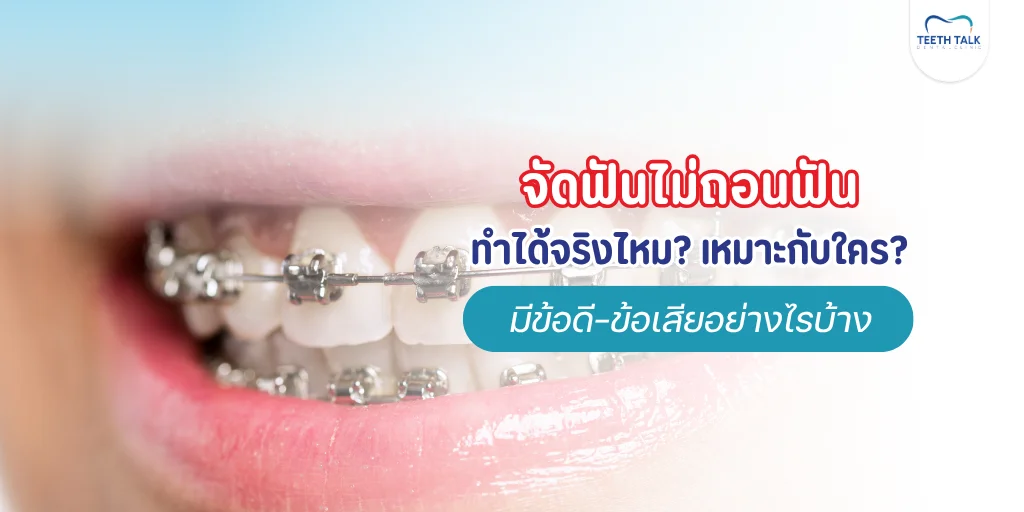 จัดฟันไม่ถอนฟัน