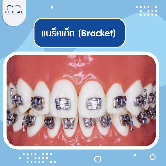 แบร็กเก็ตหลุดต้องทำอย่างไร?
