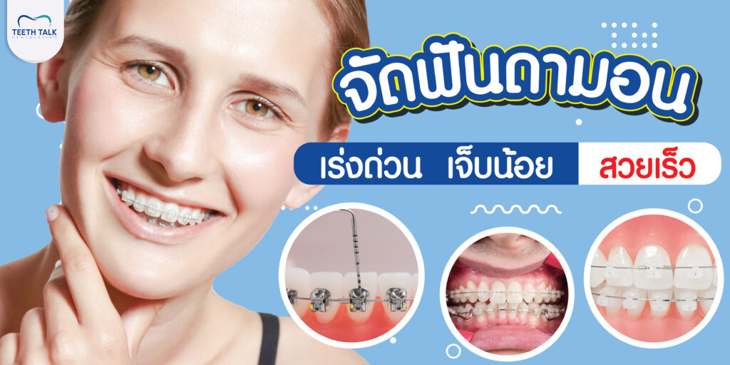 จัดฟันแบบดามอนมีข้อดี-ข้อเสียอะไรบ้าง?