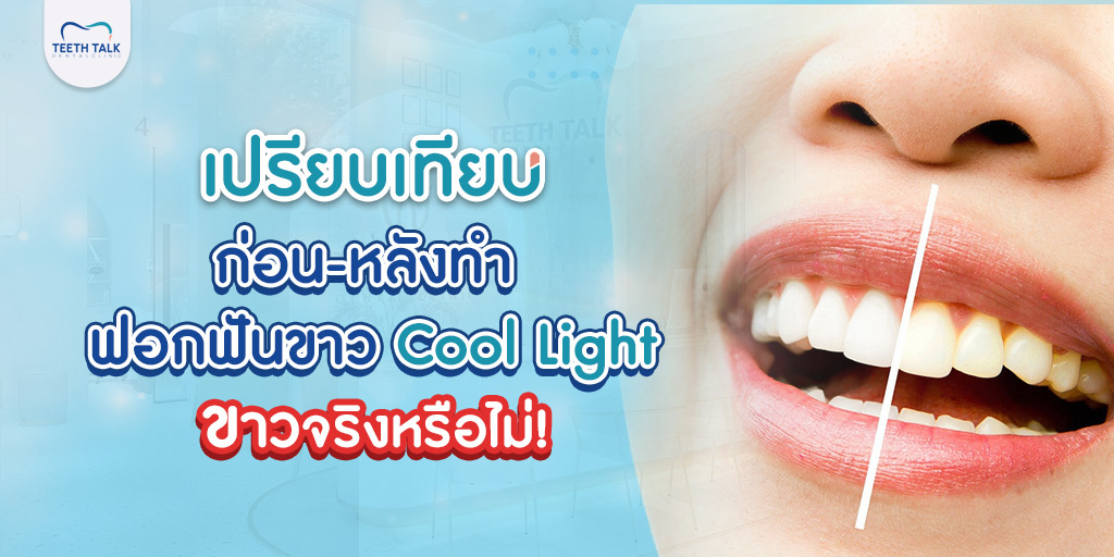 เปรียบเทียบก่อน-หลังทำ ฟอกฟันขาว Cool Light ขาวจริงหรือไม่!
