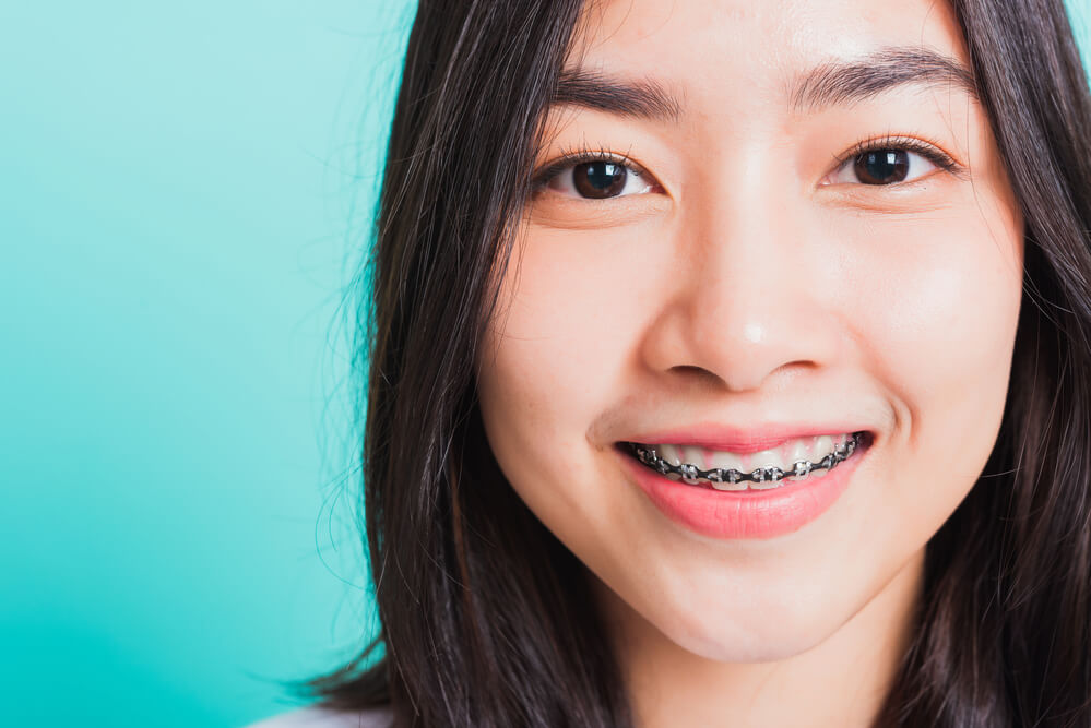 ประโยชน์ของรีเทนเนอร์แบบแบล็คเก็ต (Bracket Retainer)