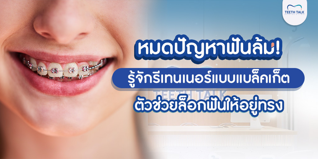 หมดปัญหาฟันล้ม! รู้จักรีเทนเนอร์แบบแบล็คเก็ต ตัวช่วยล็อกฟันให้อยู่ทรง