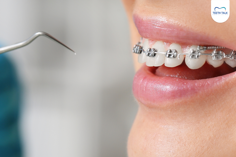 แบร็คเก็ตจัดฟันคืออะไร หลุดบ่อย ขูดปาก ทำอย่างไรดี?