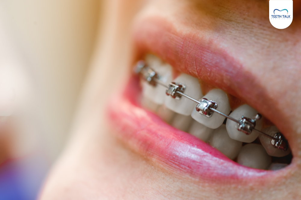 แบร็คเก็ตจัดฟันคืออะไร หลุดบ่อย ขูดปาก ทำอย่างไรดี?