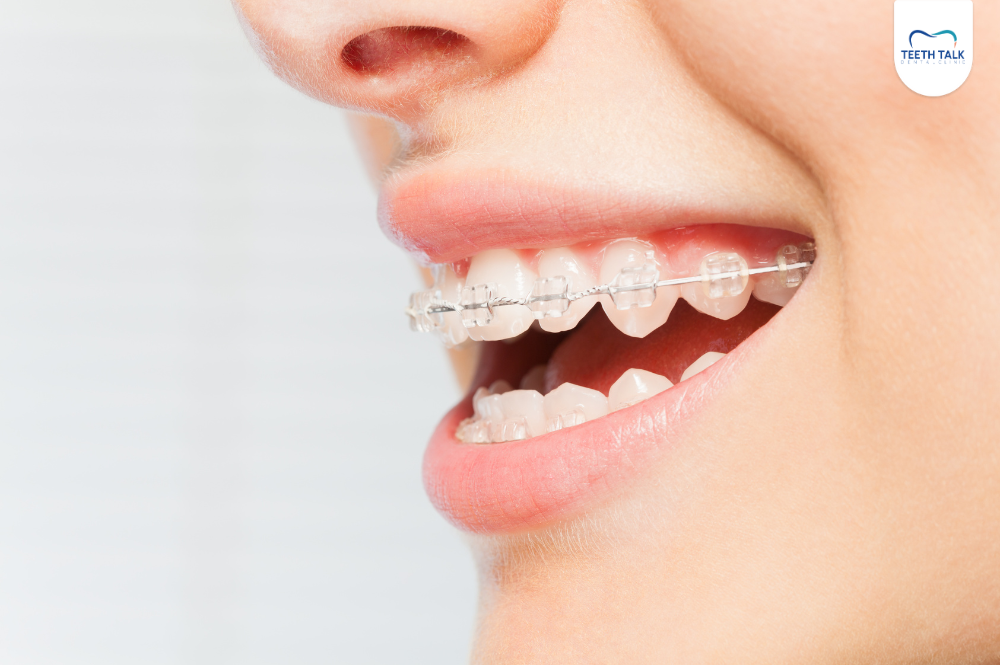 แบร็คเก็ตจัดฟันคืออะไร หลุดบ่อย ขูดปาก ทำอย่างไรดี?