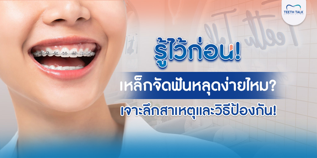 รู้ไว้ก่อน! เหล็กจัดฟันหลุดง่ายไหม? เจาะลึกสาเหตุและวิธีป้องกัน!