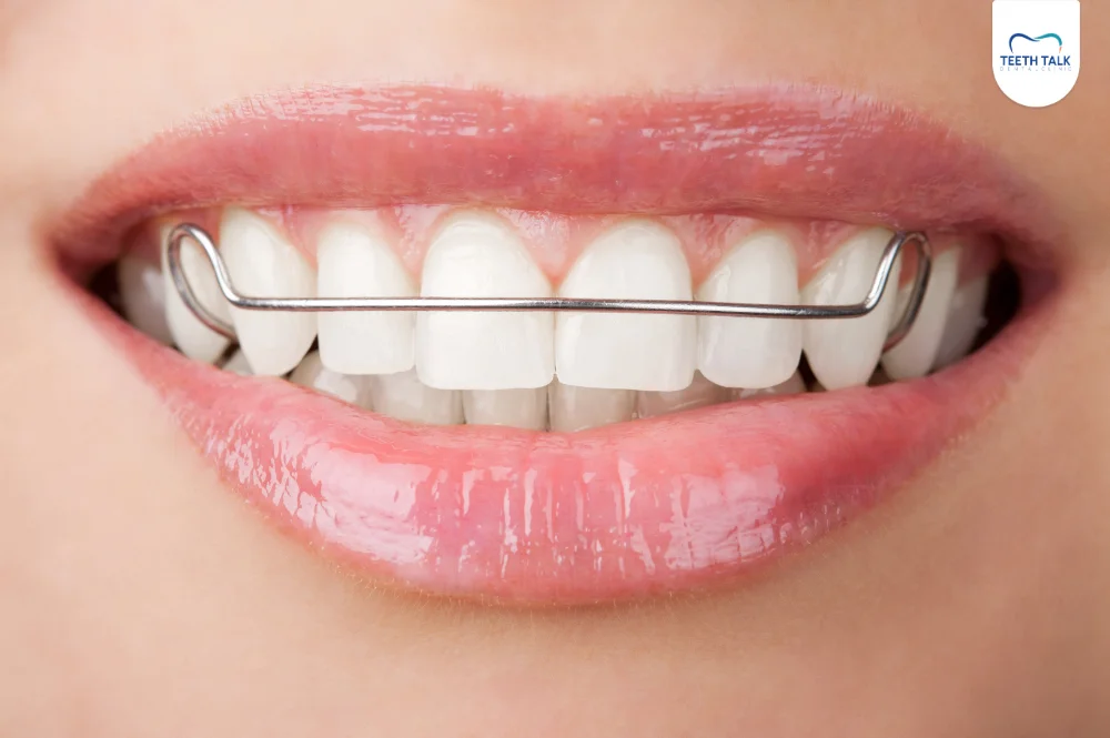 วิธีใช้งานรีเทนเนอร์อย่างถูกต้อง