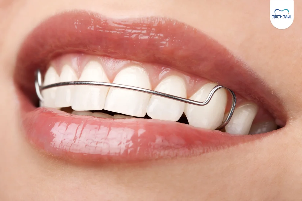 รีเทนเนอร์ลวด และรีเทนเนอร์ลวดเส้นเดียว