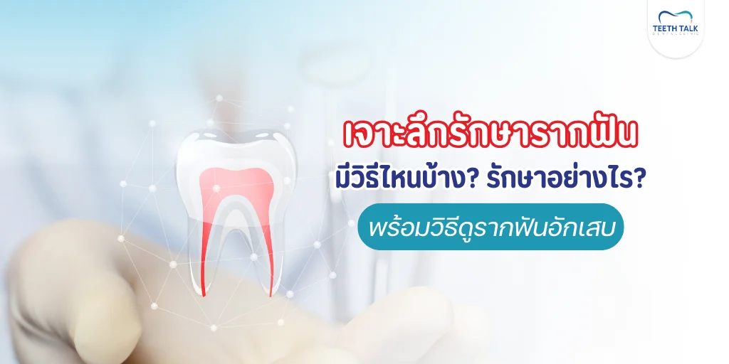 รักษารากฟันคืออะไร