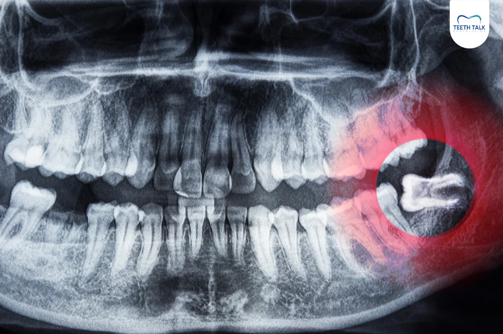 จะรู้ได้อย่างไรว่ามีฟันคุด