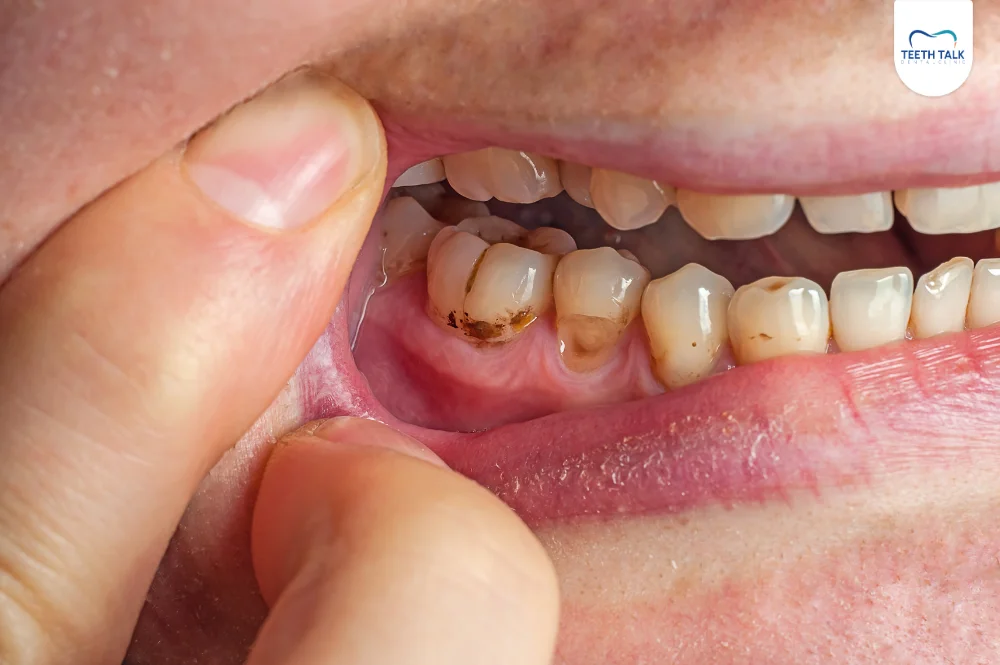 สาเหตุที่จำเป็นต้องถอนฟัน