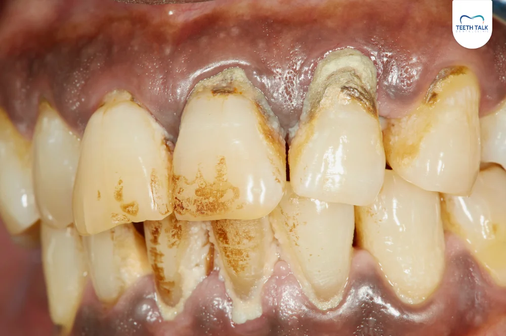 หินปูนเกิดจากอะไร