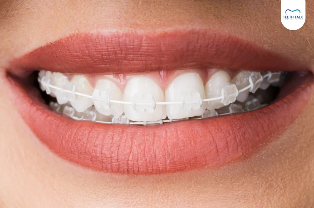 จัดฟันดามอนมีกี่ประเภท