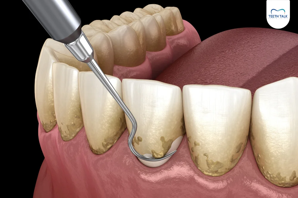 ทำไมต้องขูดหินปูน