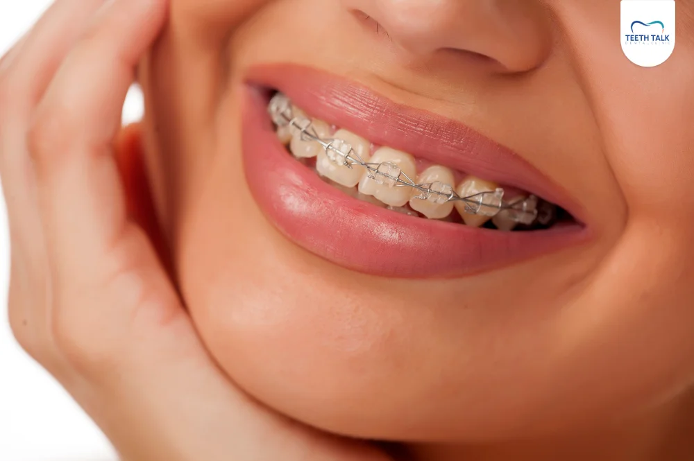 จัดฟันแบบดามอนที่ Teeth Talk Dental Clinic