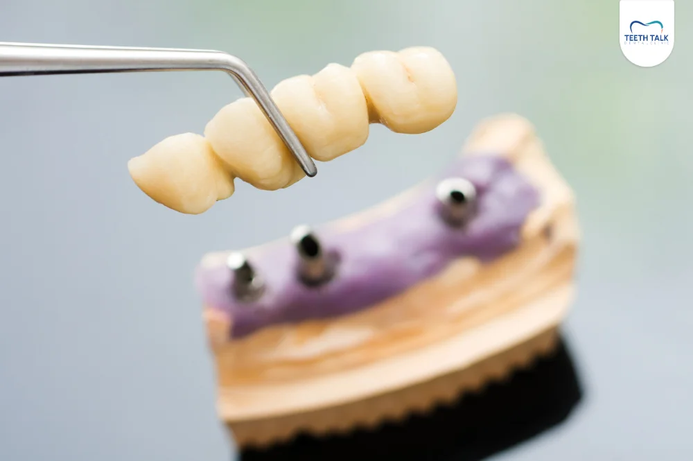 สะพานฟันมีกี่ส่วนประกอบ