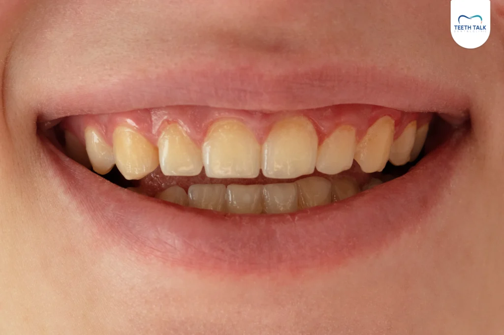 สาเหตุที่ทำให้ฟันเหลือง