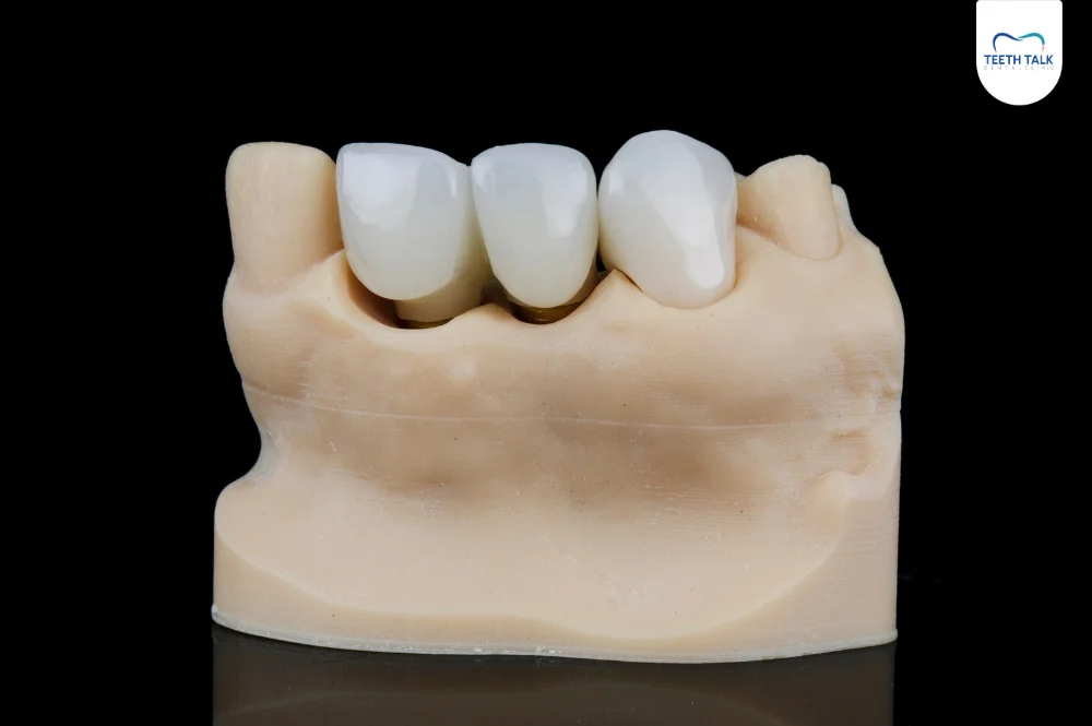 ทำไมต้องทำสะพานฟันที่ Teeth Talk Dental Clinic