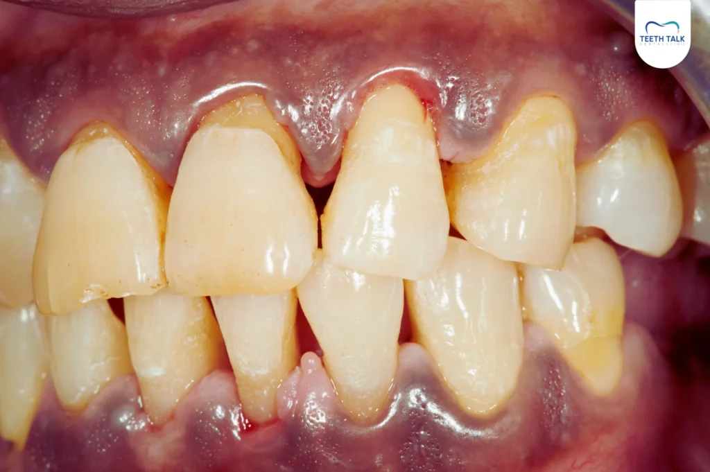 กำลังมีภาวะเหงือกร่นหรือไม่