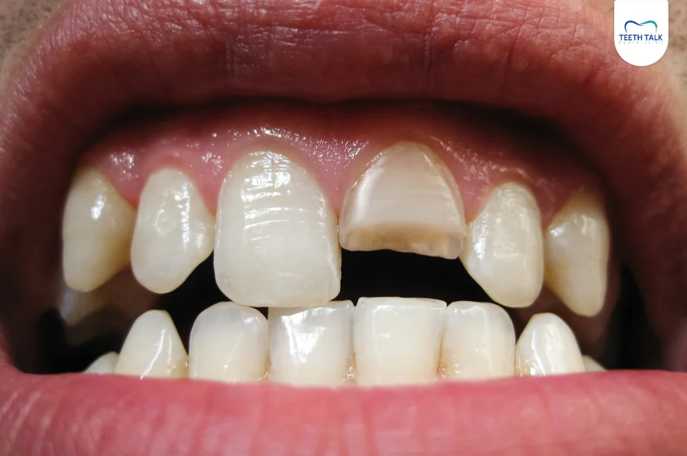 ฟันแตกรักษายังไง