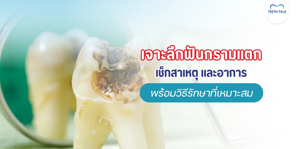 ฟันกรามแตก