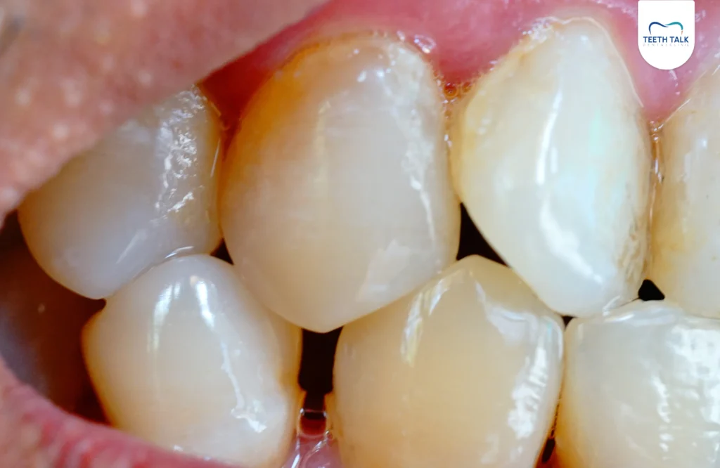 คราบพลัคเกิดจากอะไร