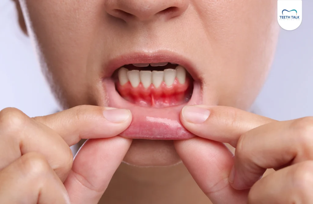 วิธีรักษาเหงือกเป็นหนอง