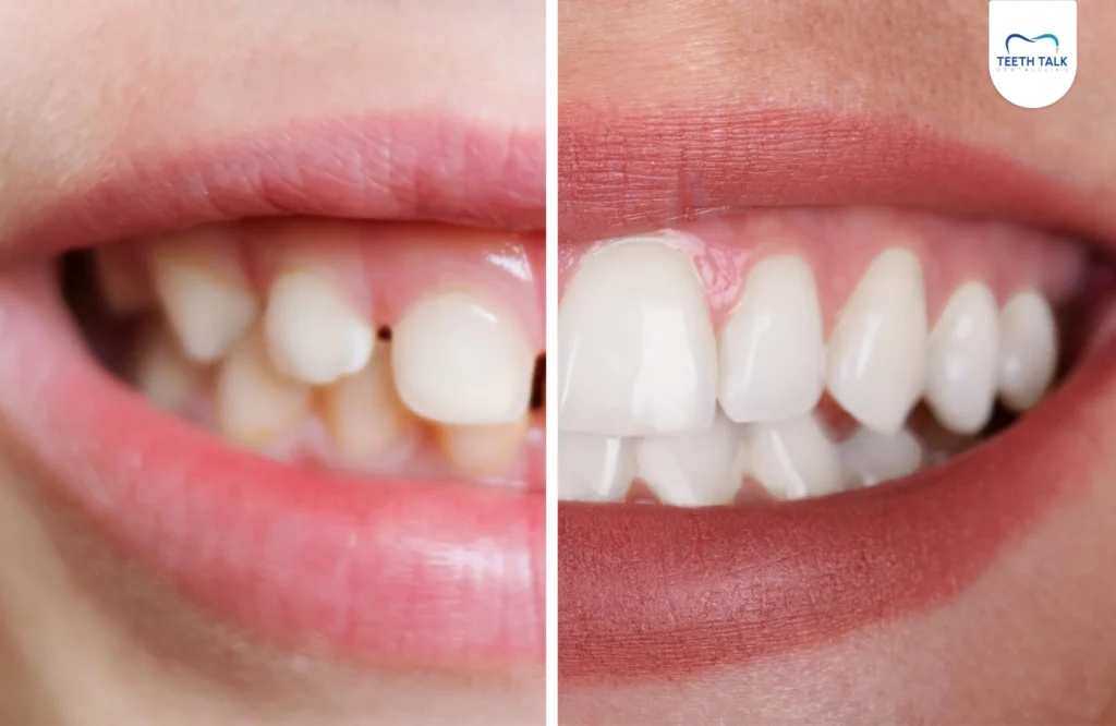 ลำดับการขึ้นของฟันแท้