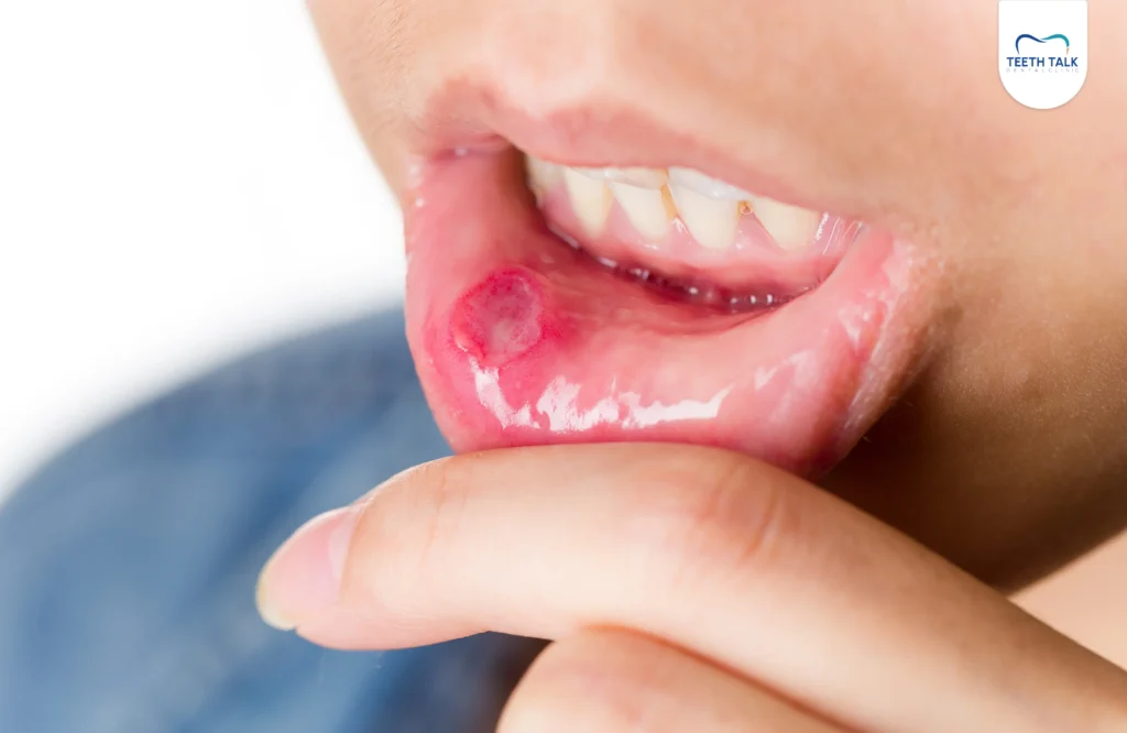 แผลในปาก 5 ประเภท