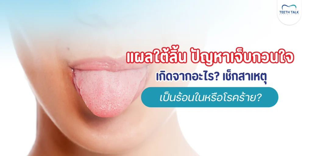 แผลใต้ลิ้น ปัญหาเจ็บกวนใจ