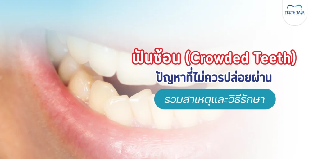 ฟันซ้อน Crowded Teeth