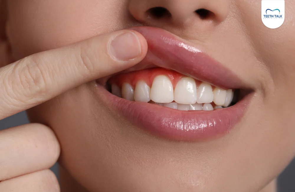 ปลูกเหงือก ที่ TEETH TALK