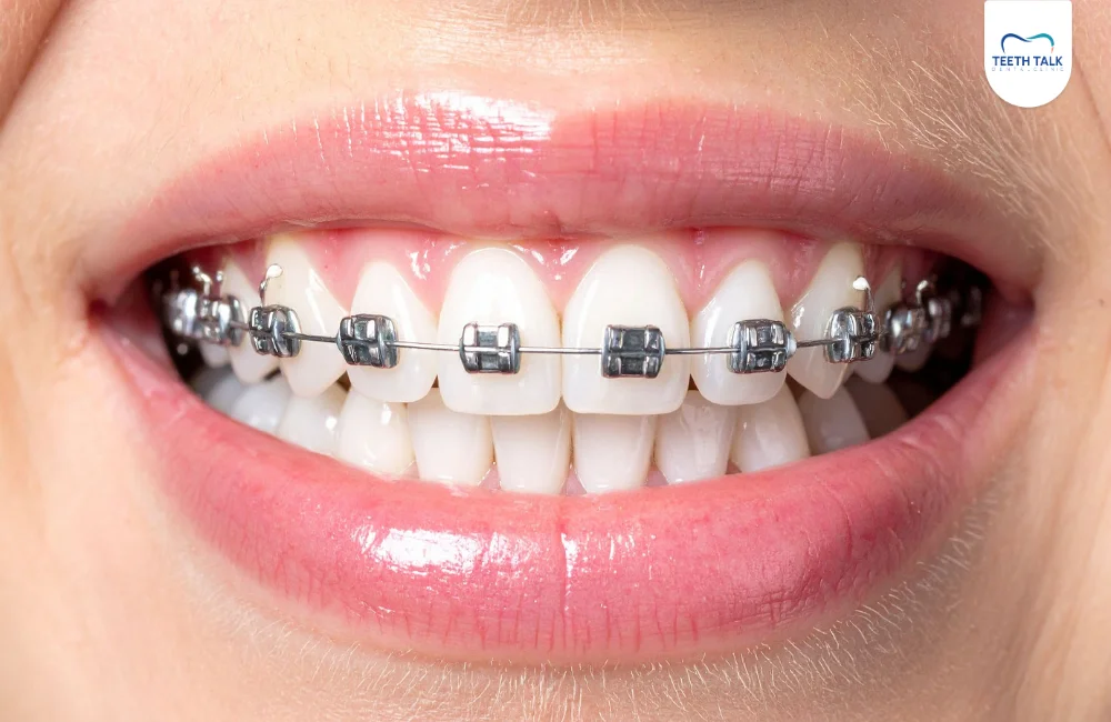 ข้อดีของการจัดฟันแบบเหล็กเส้นเดียว