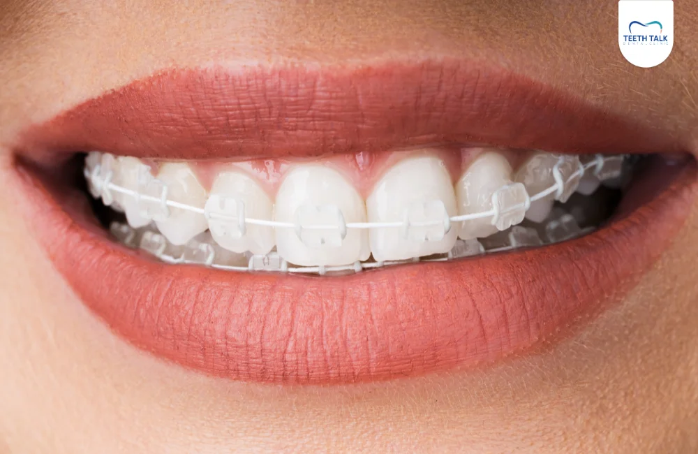 ความแตกต่างระหว่างการจัดฟันแบบเหล็กเส้นเดียวกับการจัดฟันโลหะทั่วไป