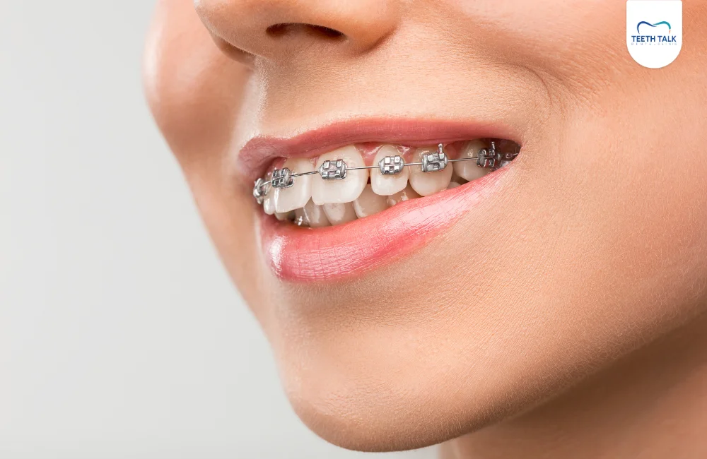 ลวดเหล็กดัดฟันหลุด