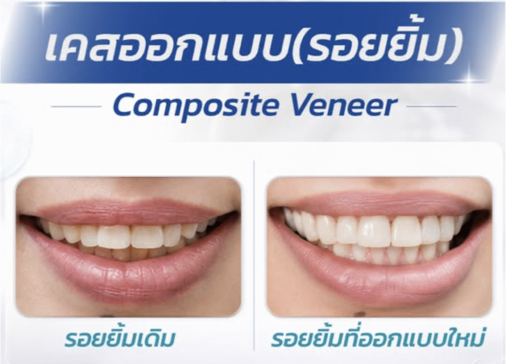 วีเนียร์ เปลี่ยนรอยยิ้มใหม่ เริ่มต้น 2,250.-/ซี่ ผ่อน 0% สูงสุด 3 เดือน