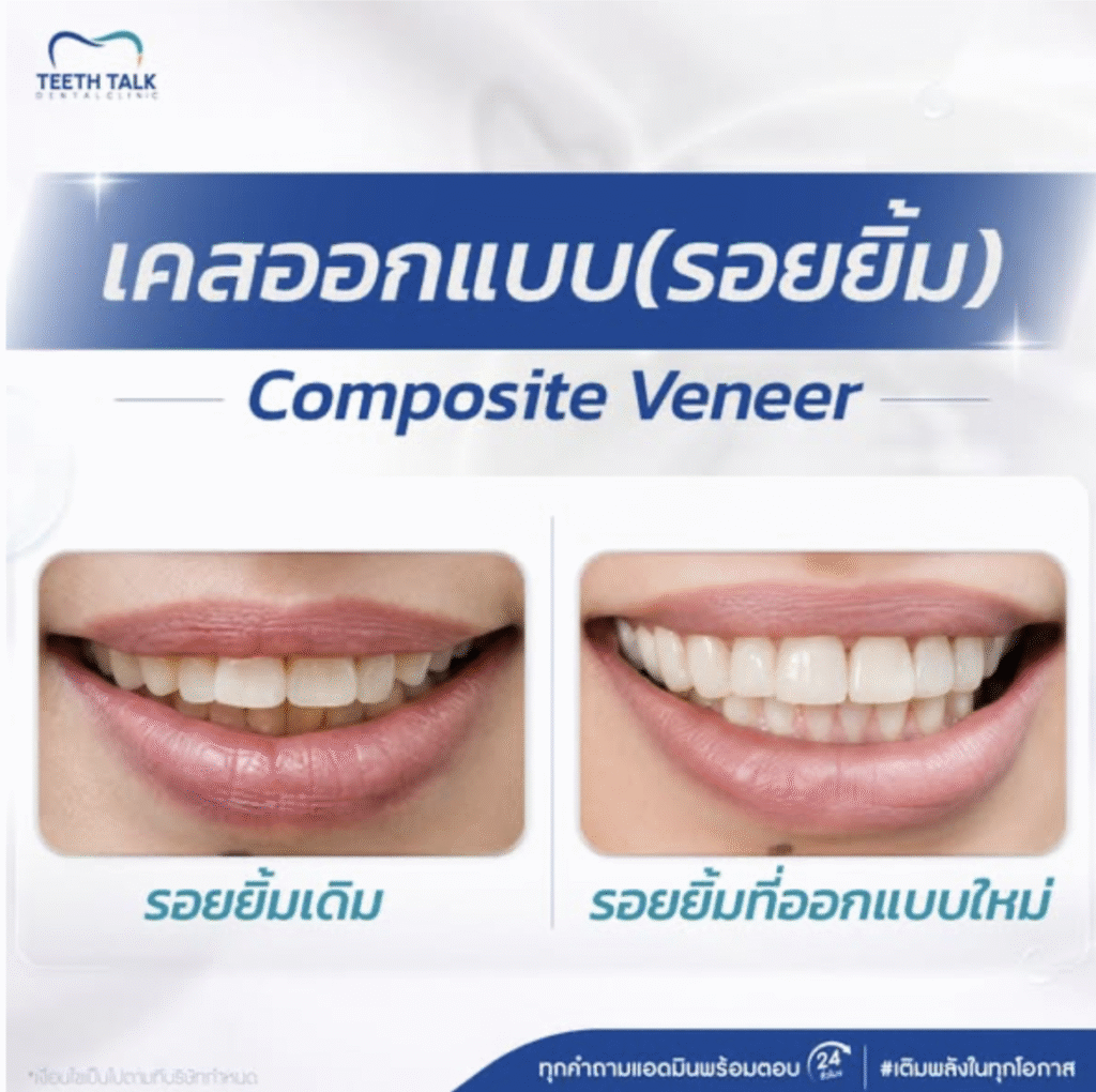 วีเนียร์ เปลี่ยนรอยยิ้มใหม่ เริ่มต้น 2,250.-/ซี่ ผ่อน 0% สูงสุด 3 เดือน