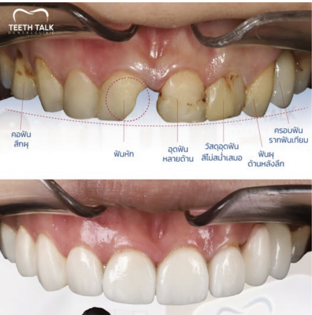วีเนียร์ เปลี่ยนรอยยิ้มใหม่ เริ่มต้น 2,250.-/ซี่ ผ่อน 0% สูงสุด 3 เดือน