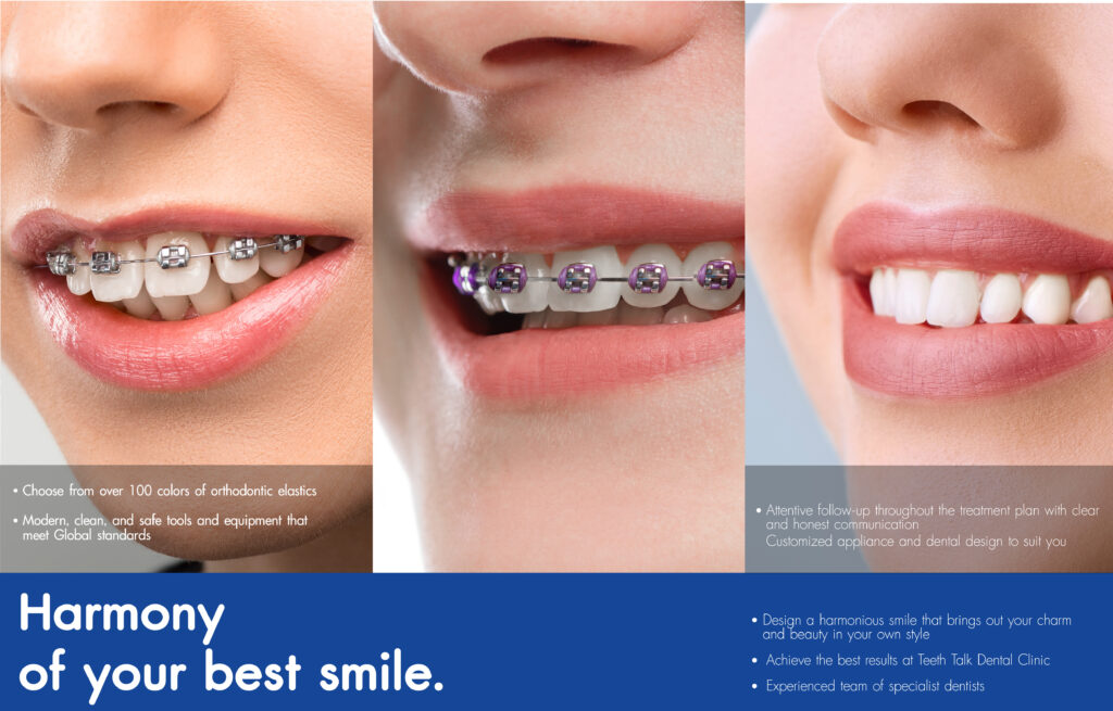 Metal Braces Promotion Starting from THB 999/month FREE! 8 Exclusive Benefits