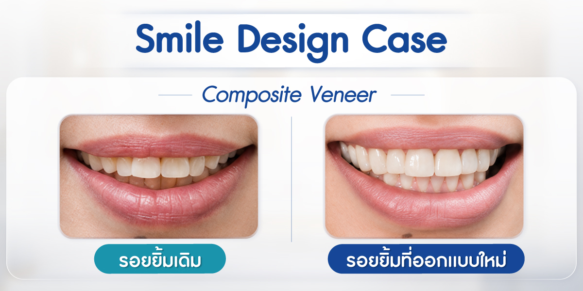 วีเนียร์ เปลี่ยนรอยยิ้มใหม่ เริ่มต้น 2,250.-/ซี่ ผ่อน 0% สูงสุด 3 เดือน