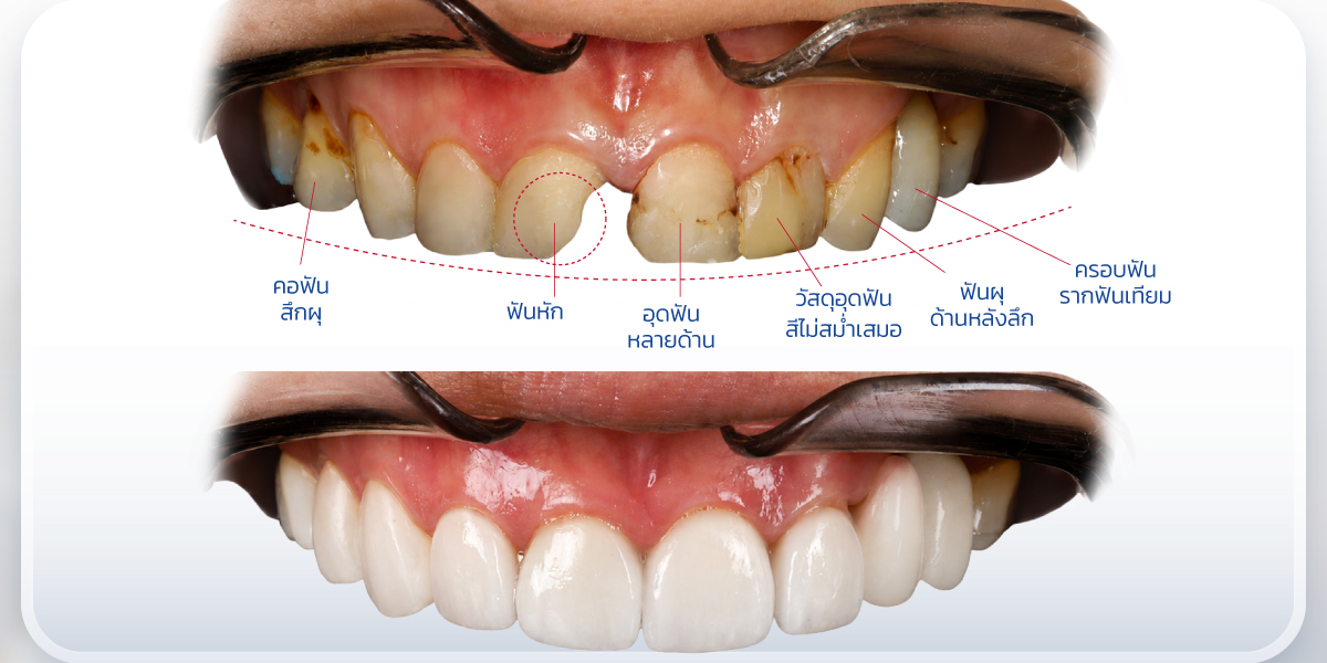วีเนียร์ เปลี่ยนรอยยิ้มใหม่ เริ่มต้น 2,250.-/ซี่ ผ่อน 0% สูงสุด 3 เดือน